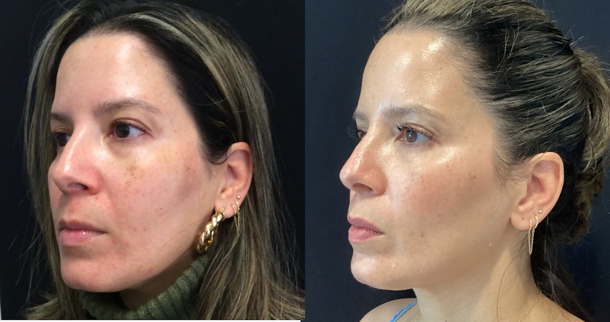 glp 1 skin serum before and after Q&A: How Dermatologist Kim Nichols Integrates Hydrafacial Into Skin  Protocols for GLP-1 Patients
