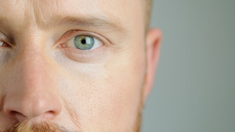 While it may be tempting to use female-centric protocols or 'plug-and-play' treatment paradigms, doing so risks patient dissatisfaction and poor aesthetic results. Male non-surgical procedures such as Botox, dermal fillers and biostimulators require anatomical accuracy and self-control.