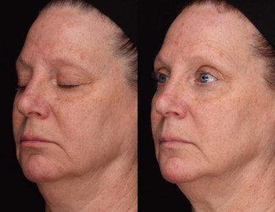 Case 1a: Eyes closed versus normal.