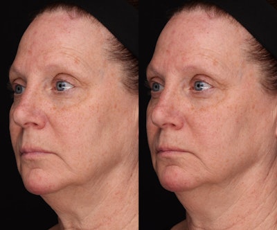 Case 3a: Normal versus out of focus full face.