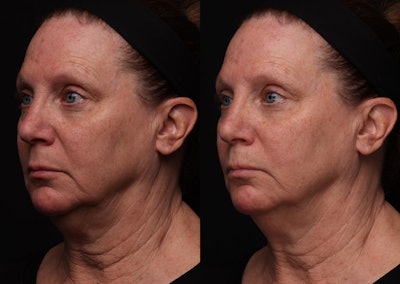 Case 4a: Lower light half power full face.