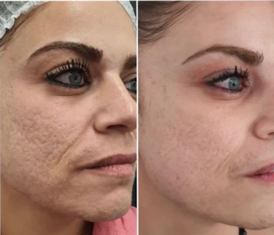 Acne Filter Effect The New Era of Acne Management: Clearer Skin, Trusted Devices, Proven ...