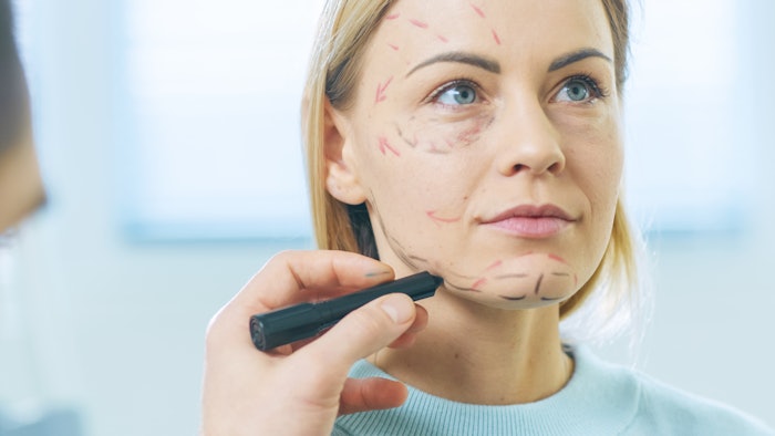 The quilting technique, or hemostatic netting, places sutures on the skin’s exterior to anchor it to the underlying fascia, eliminating the use of external drains to manage fluid buildup and prevent a common result of facelifts: hematoma.