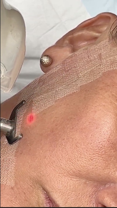 Sciton ProFractional