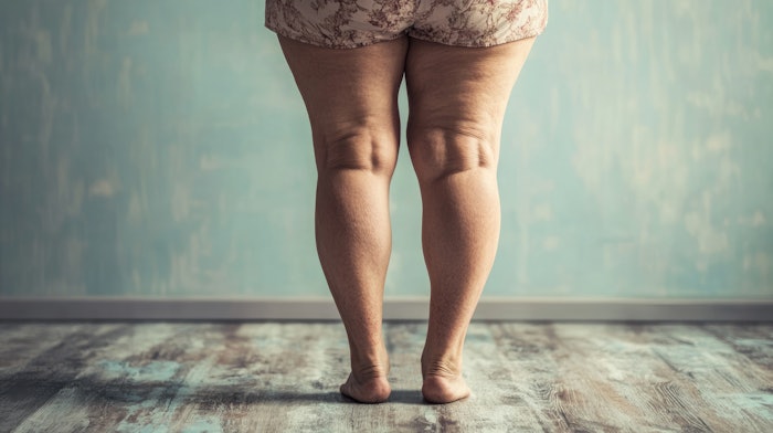 Most lipedema diagnoses come from non-surgeons, often years after symptoms begin—highlighting the urgent need for earlier recognition by aesthetic professionals.