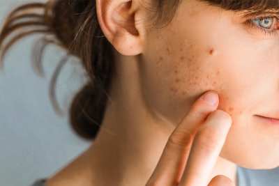 Dermatologists explain that it’s not the oil itself that prevents wrinkles—it’s the long-term use of acne treatments and better skin hydration that make the difference.