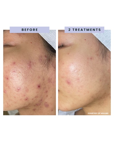 SkinSpirit Clear + Even Clarifier Catalyst Serum: Acne Scar Treatment Finalist