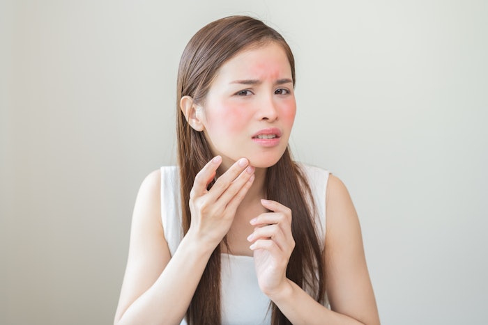 Woman With Itchy Red Skin Irritated Hurt Red Adobe Stock 1096675647