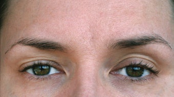 Ptosis is the second most common surgery Eftekhari performs at the Eyelid Center of Utah, after upper eyelid blepharoplasty.