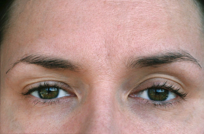 Ptosis is the second most common surgery Eftekhari performs at the Eyelid Center of Utah, after upper eyelid blepharoplasty.