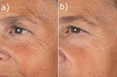Medik8’s Liquid Peptides Advanced MP Serum is clinically proven to improve the look of deep-set wrinkles; a) before treatment; b) after 8 weeks of treatment
