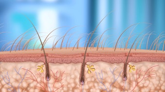 Designed for thicker skin, the MicronJet 800 expands applications from hair restoration to aesthetic and dermatological treatments.