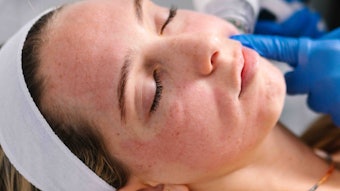 GLP-1 medications are driving rapid weight loss, creating new aesthetic needs. Matrix™ by Candela offers non-surgical solutions to restore facial volume and enhance texture, helping clinics meet patient demand.