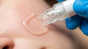 The strong demand for SkinPen underscores rapid growth of microneedling
