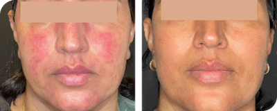 Aerolase Neo: Laser Therapy for Chronic Skin Inflammation