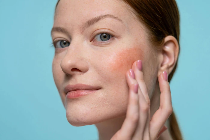 Many current “sensitive skin” formulations are designed around anti-inflammatory mechanisms used in rosacea management, including approaches targeting Demodex and antimicrobial peptide activity.