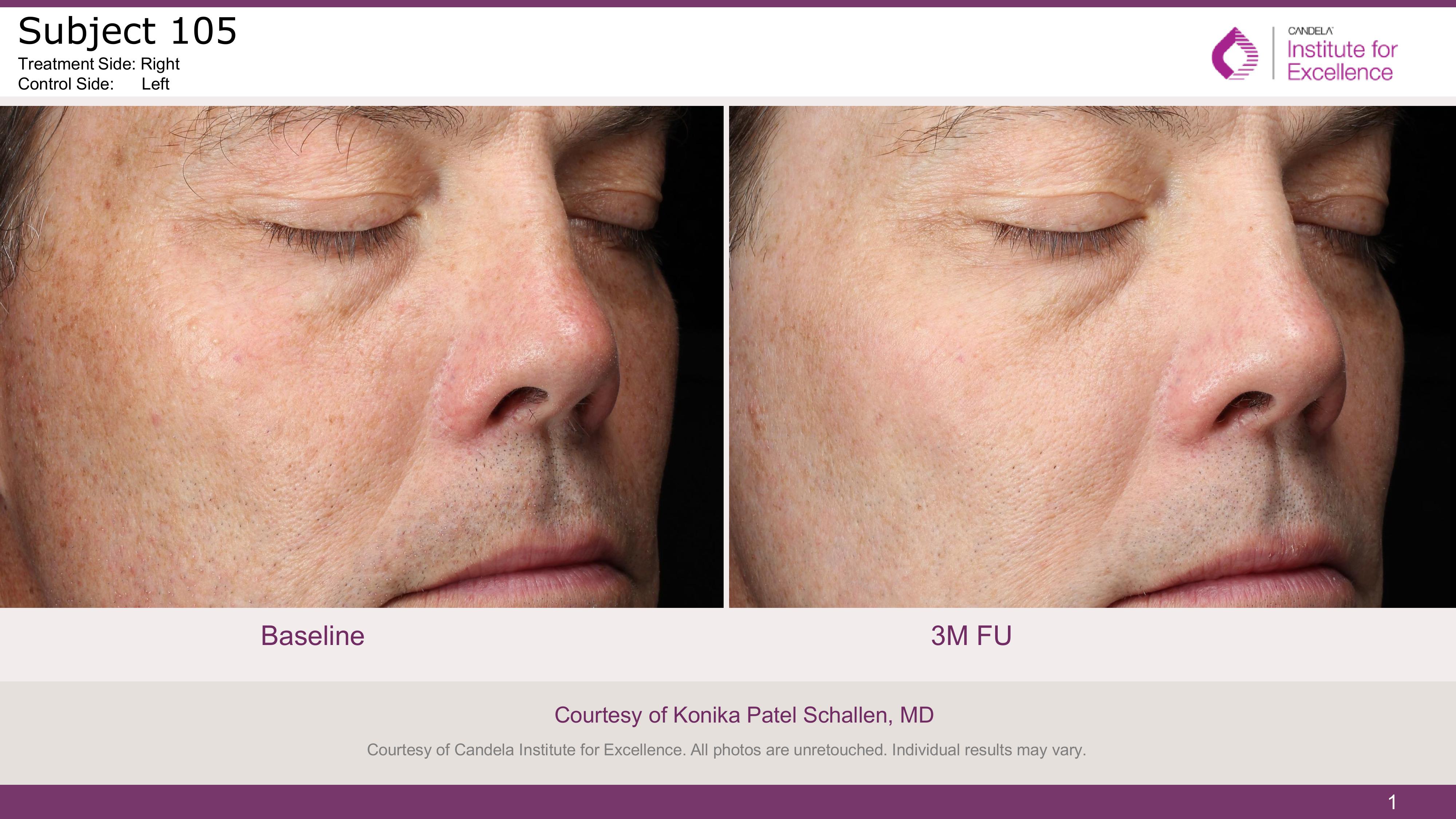 Courtesy of Candela Institute for Excellence. All photos are unretouched. Individual results may vary