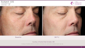 Courtesy of Candela Institute for Excellence. All photos are unretouched. Individual results may vary