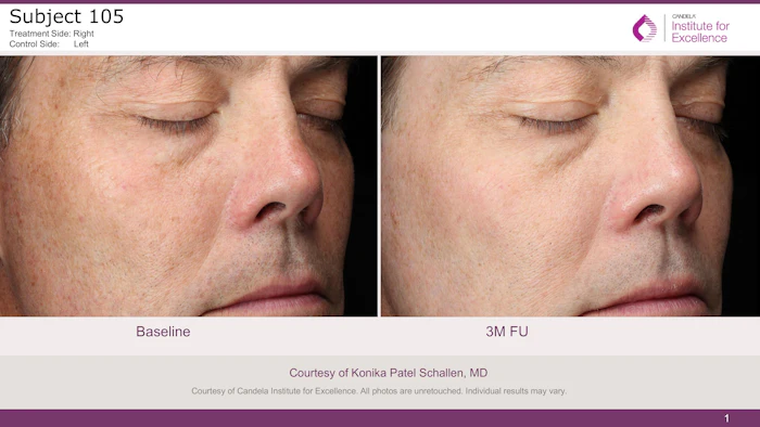 Courtesy of Candela Institute for Excellence. All photos are unretouched. Individual results may vary