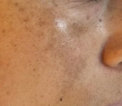 Melasma: confluent, symmetric patches with poorly defined borders, concentrated in the malar region. This is the same patient as Figure 1, a mixed presentation that shows how often the two conditions coexist in everyday practice.
