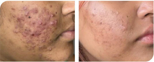 Aerolase Neo Elite: Clinical Evidence for Acne Success