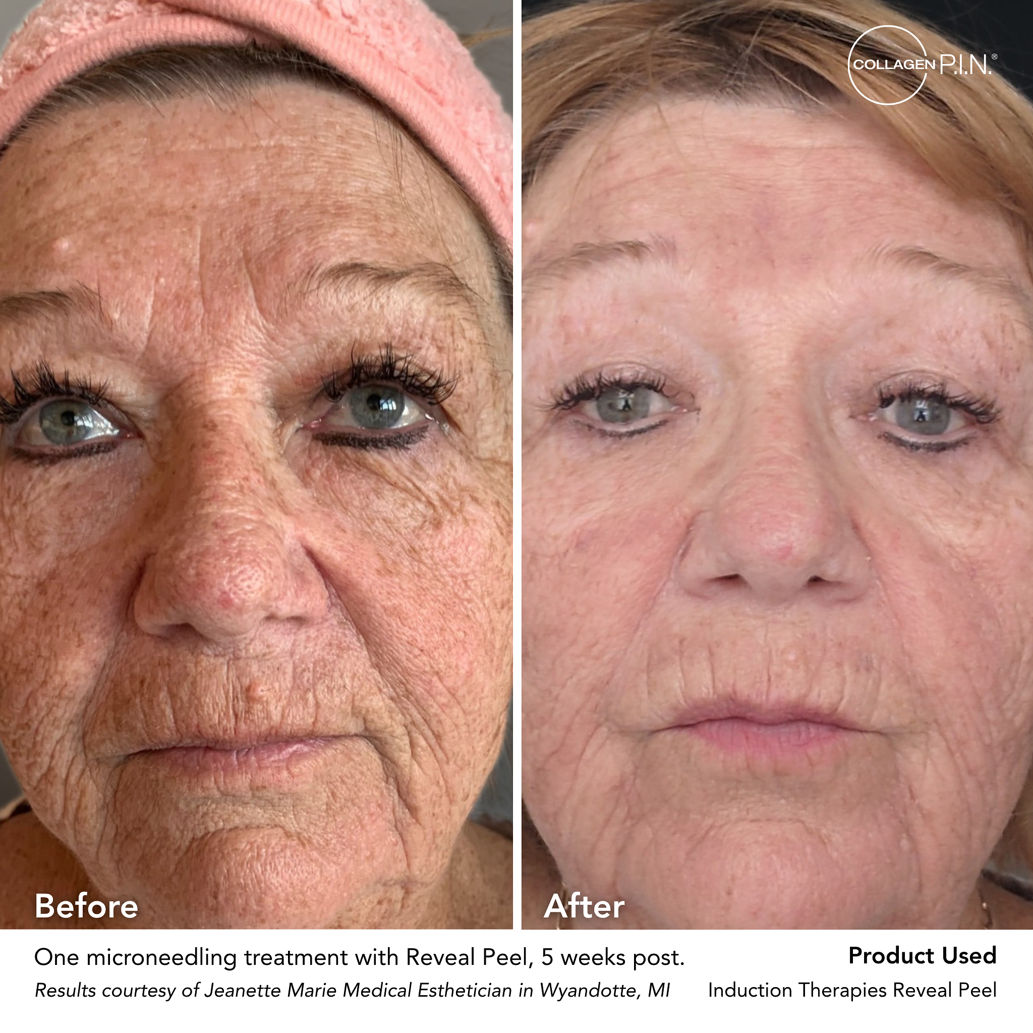 Results Courtesy Of Jeanette Marie Medical Esthetician In Wyandotte Mi