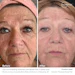 Results Courtesy Of Jeanette Marie Medical Esthetician In Wyandotte Mi