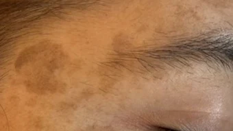 Solar Melanosis