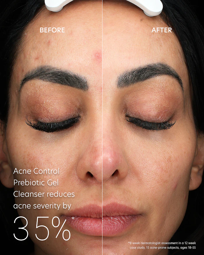 Before and after results from using PCA Skin's Acne Prebiotic Gel Cleanser.