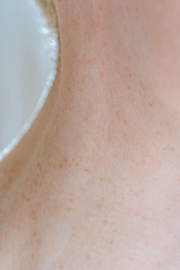 Close-up of fair skin with freckles and light spots near shoulder