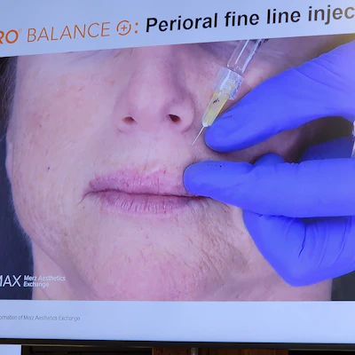 Perioral fine line injection procedure demonstration with medical professional administering treatment around mouth area