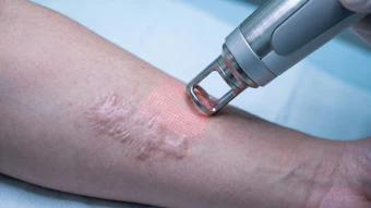 Laser or microneedling device treating facial scars on patient skin during cosmetic procedure